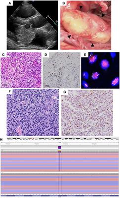 Case report: Navigating treatment pathways for cardiac intimal sarcoma with PDGFRβ N666K mutation